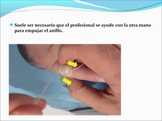 Suele ser necesario que el profesional se ayude con la otra mano
para empujar el anillo.
 