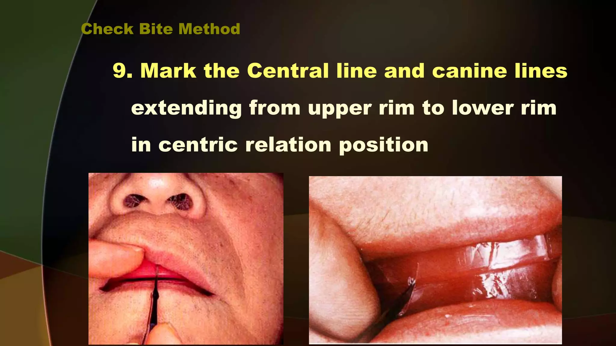Complete Denture 4- Maxillo-mandibular Relation Records d- Centric ...