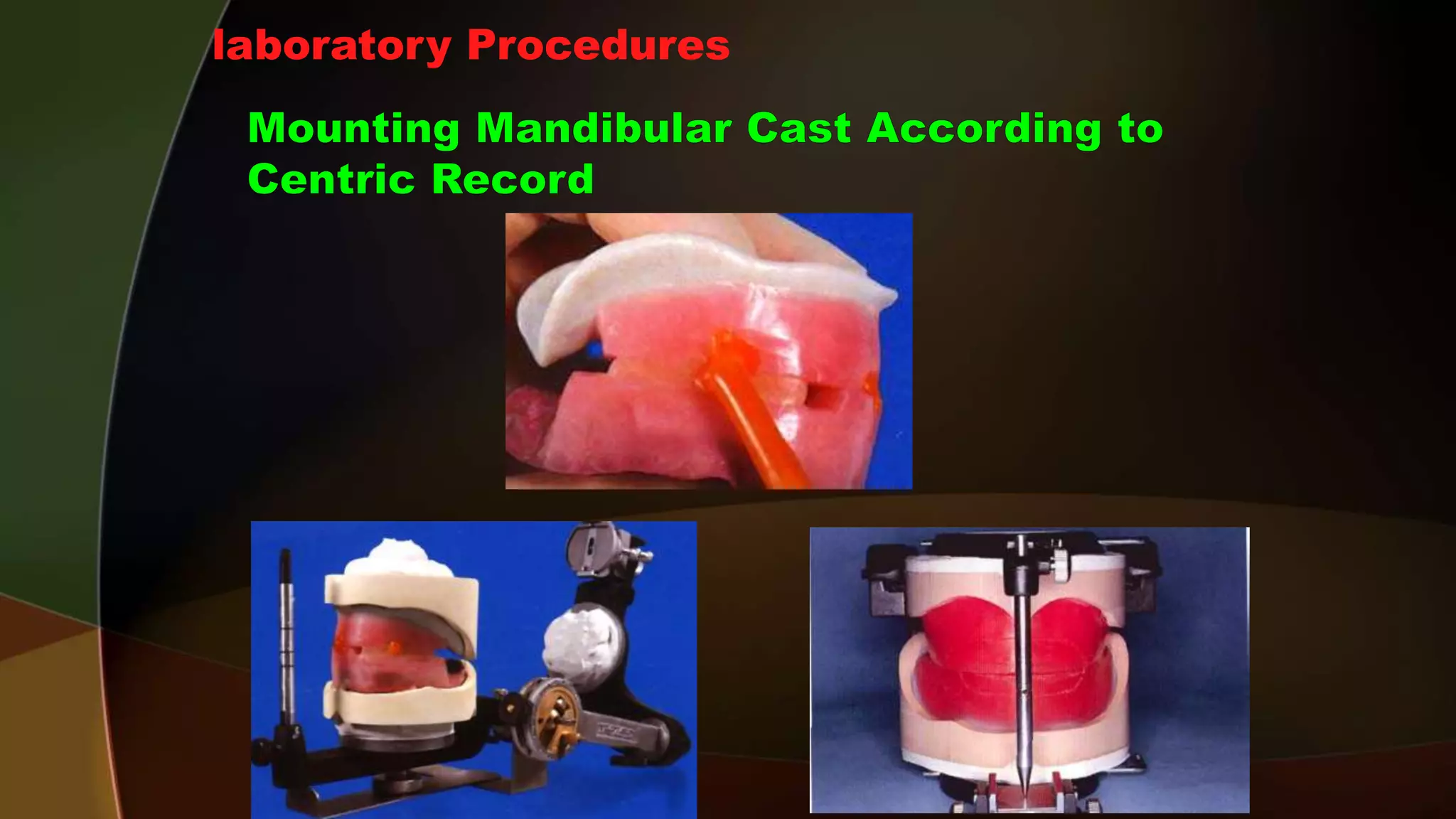 Complete Denture 4 Maxillomandibular Relation Records d Centric Relation Registration PPT