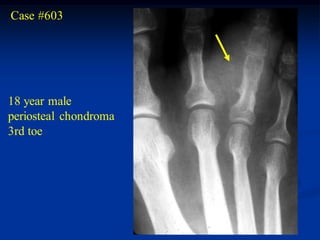 Case #603




18 year male
periosteal chondroma
3rd toe
 