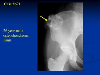 Case #621




26 year male
osteochondroma
ilium
 