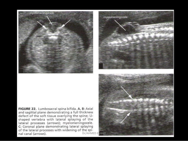 4-fetal spine Dr Ahmed Esawy
