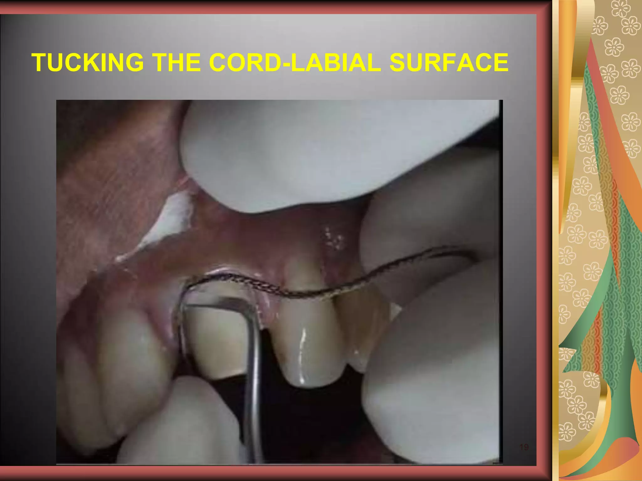 4 Gingival Retraction & Impressions.ppt