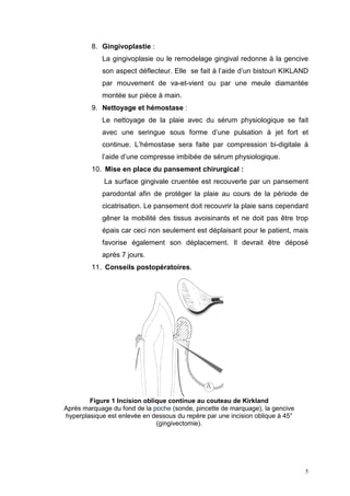 8. Gingivoplastie :
La gingivoplasie ou le remodelage gingival redonne à la gencive
son aspect déflecteur. Elle se fait à l’aide d’un bistouri KIKLAND
par mouvement de va-et-vient ou par une meule diamantée
montée sur pièce à main.
9. Nettoyage et hémostase :
Le nettoyage de la plaie avec du sérum physiologique se fait
avec une seringue sous forme d’une pulsation à jet fort et
continue. L’hémostase sera faite par compression bi-digitale à
l’aide d’une compresse imbibée de sérum physiologique.
10. Mise en place du pansement chirurgical :
La surface gingivale cruentée est recouverte par un pansement
parodontal afin de protéger la plaie au cours de la période de
cicatrisation. Le pansement doit recouvrir la plaie sans cependant
gêner la mobilité des tissus avoisinants et ne doit pas être trop
épais car ceci non seulement est déplaisant pour le patient, mais
favorise également son déplacement. Il devrait être déposé
après 7 jours.
11. Conseils postopératoires.
Figure 1 Incision oblique continue au couteau de Kirkland
Après marquage du fond de la poche (sonde, pincette de marquage), la gencive
hyperplasique est enlevée en dessous du repère par une incision oblique à 45°
(gingivectomie).
5
 