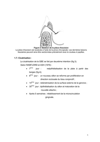 Figure 2 Ablation de la pièce d'excision
La pièce d'excision est soulevée à l'aide de la pince chirurgicale. Les dernières liaisons
tissulaires peuvent ainsi être sectionnées précisément avec le couteau à papilles.
1.7- Cicatrisation :
La cicatrisation de la GBE se fait par deuxième intention (fig.3).
Selon RAMFJORD et ASH (1979) :
• 7
ème
jour : reépithélialisation de la plaie à partir des
berges (fig.4);
• 8
ème
jour : un nouveau sillon se reforme par prolifération en
direction occlusale du tissu conjonctif ;
• 14
ème
jour : rekératinisation de la surface externe de la gencive ;
• 35
ème
jour : épithélialisation du sillon et maturation de la
nouvelle attache ;
• Après 5 semaines : rétablissement de la microcirculation
gingivale.
6
 