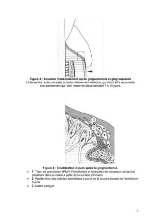 Figure 3 : Situation immédiatement après gingivectomie et gingivoplastie
L'intervention crée une plaie ouverte relativement étendue, qui devra être recouverte
d'un pansement qui doit rester en place pendant 7 à 10 jours.
.
Figure 4 : Cicatrisation 2 jours après la gingivectomie.
• 1 Tissu de granulation (PMN. Fibroblastes et ébauches de vaisseaux sanguins)
pénétrant dans le caillot à partir de la surface d'incision
• 2 Prolifération des cellules épithéliales à partir de la couche basale de l'épithélium
buccal
• 3 Caillot sanguin
7
 