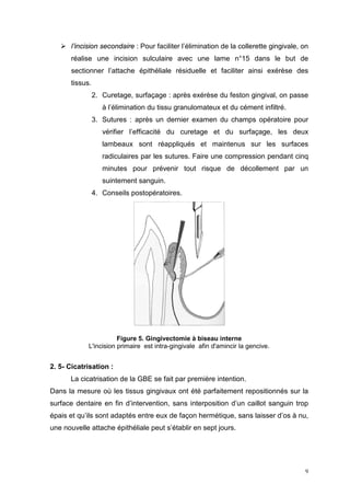  l’incision secondaire : Pour faciliter l’élimination de la collerette gingivale, on
réalise une incision sulculaire avec une lame n°15 dans le but de
sectionner l’attache épithéliale résiduelle et faciliter ainsi exérèse des
tissus.
2. Curetage, surfaçage : après exérèse du feston gingival, on passe
à l’élimination du tissu granulomateux et du cément infiltré.
3. Sutures : après un dernier examen du champs opératoire pour
vérifier l’efficacité du curetage et du surfaçage, les deux
lambeaux sont réappliqués et maintenus sur les surfaces
radiculaires par les sutures. Faire une compression pendant cinq
minutes pour prévenir tout risque de décollement par un
suintement sanguin.
4. Conseils postopératoires.
Figure 5. Gingivectomie à biseau interne
L'incision primaire est intra-gingivale afin d'amincir la gencive.
2. 5- Cicatrisation :
La cicatrisation de la GBE se fait par première intention.
Dans la mesure où les tissus gingivaux ont été parfaitement repositionnés sur la
surface dentaire en fin d’intervention, sans interposition d’un caillot sanguin trop
épais et qu’ils sont adaptés entre eux de façon hermétique, sans laisser d’os à nu,
une nouvelle attache épithéliale peut s’établir en sept jours.
9
 
