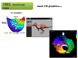 1993 - Isochronal            meet 3-D graphics...
maps
                            meet 3-D graphics...




    ...Electro-anatomic mapping is born
 