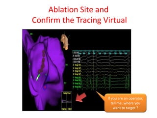 Ablation Site and
Confirm the Tracing Virtual




                     If you are an operator,
                        tell me, where you
                         want to target ?
 