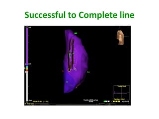 Successful to Complete line
 