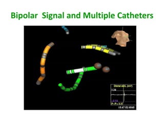 Bipolar Signal and Multiple Catheters
 