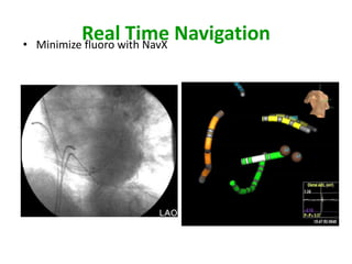 •
            Realwith NavX Navigation
    Minimize fluoro
                    Time
 