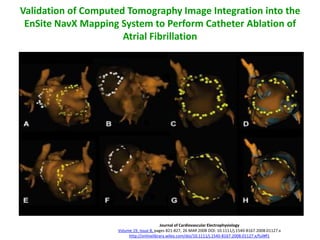 Validation of Computed Tomography Image Integration into the
 EnSite NavX Mapping System to Perform Catheter Ablation of
                      Atrial Fibrillation




                                          Journal of Cardiovascular Electrophysiology
                    Volume 19, Issue 8, pages 821-827, 26 MAR 2008 DOI: 10.1111/j.1540-8167.2008.01127.x
                         http://onlinelibrary.wiley.com/doi/10.1111/j.1540-8167.2008.01127.x/full#f1
 