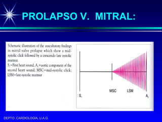 PROLAPSO V.  MITRAL: 