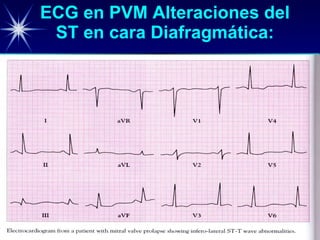 ECG en PVM Alteraciones del ST en cara Diafragmática: 