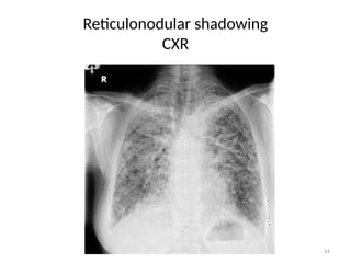 14
Reticulonodular shadowing
CXR
 
