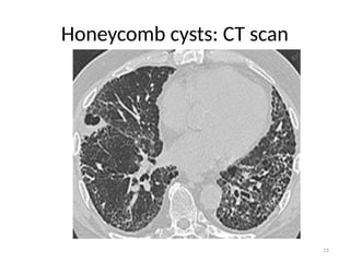 15
Honeycomb cysts: CT scan
 