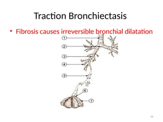 16
Traction Bronchiectasis
• Fibrosis causes irreversible bronchial dilatation
 