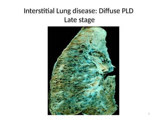 3
Interstitial Lung disease: Diffuse PLD
Late stage
 