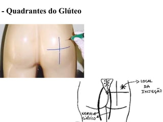 - Quadrantes do Glúteo
 