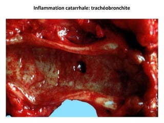 Inflammation catarrhale: trachéobronchite
 