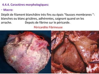 4.4.4. Caractères morphologiques:
- Macro:
Dépôt de filament blanchâtre très fins ou épais "fausses membranes ":
blanches ou blanc grisâtres, adhérentes, saignant quand on les
arrache. Depots de fibrine sur le péricarde.
Péricardite Fibrineuse
 