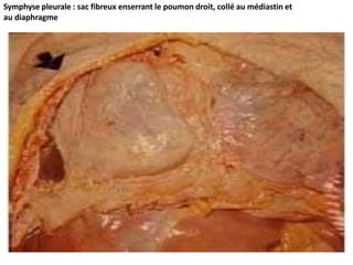 Symphyse pleurale : sac fibreux enserrant le poumon droit, collé au médiastin et
au diaphragme
 