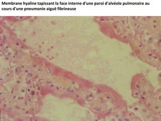 Membrane hyaline tapissant la face interne d'une paroi d'alvéole pulmonaire au
cours d'une pneumonie aiguë fibrineuse
 
