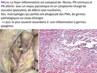 Micro: Le foyer inflammatoire est composé de: fibrine, PN normaux et
PN altérés avec un noyau pycnotique et un cytoplasme chargé de
vacuoles (pyocytes), de débris cyto-nucléaires,
Des macrophages qui parfois ont phagocyté des PNA, de germes
pathologiques ou corps étranges
=> pus: le plus souvent secondaire à une inflammation à germes
pyogènes
 
