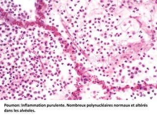 Poumon: Inflammation purulente. Nombreux polynucléaires normaux et altérés
dans les alvéoles.
 