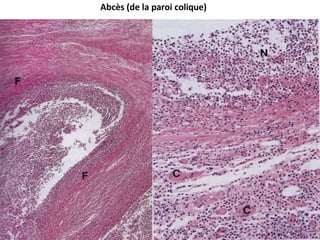 Abcès (de la paroi colique)
 