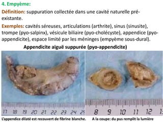 4. Empyème:
Définition: suppuration collectée dans une cavité naturelle pré-
existante.
Exemples: cavités séreuses, articulations (arthrite), sinus (sinusite),
trompe (pyo-salpinx), vésicule biliaire (pyo-cholécyste), appendice (pyo-
appendicite), espace limité par les méninges (empyème sous-dural).
Appendicite aiguë suppurée (pyo-appendicite)
L’appendice dilaté est recouvert de fibrine blanche. A la coupe: du pus remplit la lumière
 