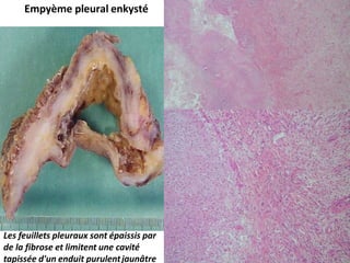 Empyème pleural enkysté
Les feuillets pleuraux sont épaissis par
de la fibrose et limitent une cavité
tapissée d'un enduit purulentjaunâtre
 
