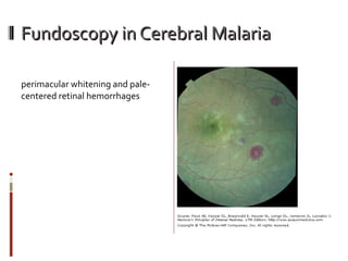 Fundoscopy in Cerebral Malaria perimacular whitening and pale-centered retinal hemorrhages 