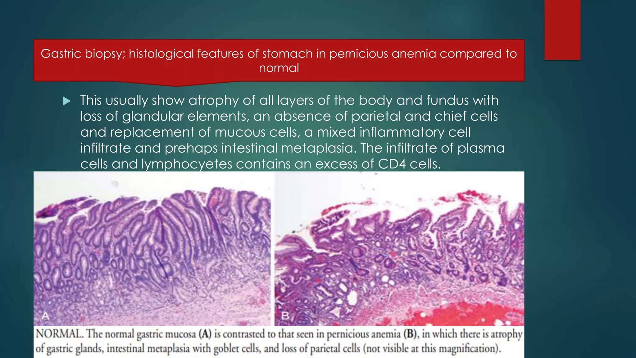  This usually show atrophy of all layers of the body and fundus with
loss of glandular elements, an absence of parietal and chief cells
and replacement of mucous cells, a mixed inflammatory cell
infiltrate and prehaps intestinal metaplasia. The infiltrate of plasma
cells and lymphocyetes contains an excess of CD4 cells.
Gastric biopsy; histological features of stomach in pernicious anemia compared to
normal
 
