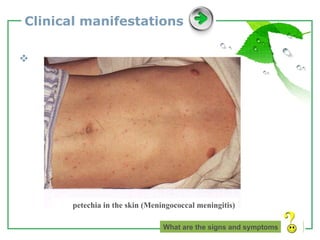 Clinical manifestations What are the signs and symptoms petechia in the skin (Meningococcal meningitis) 