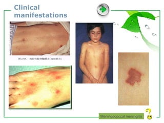 Clinical manifestations Meningococcal meningitis 