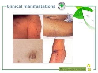 Clinical manifestations Meningococcal meningitis 
