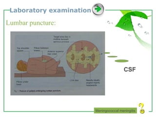 Laboratory examination Lumbar puncture: Meningococcal meningitis CSF 