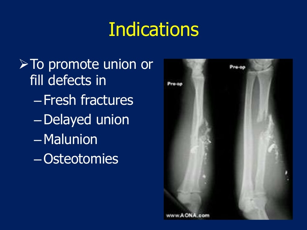 Bone Grafting In Orthopedic
