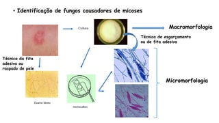 • Identificação de fungos causadores de micoses
Macromorfologia
Micromorfologia
Técnica de esgarçamento
ou de fita adesiva
Técnica da fita
adesiva ou
raspado de pele
 