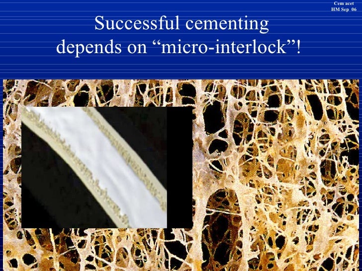 Modern Cementing Technique Femur