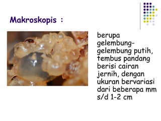 Makroskopis :
                berupa
                gelembung-
                gelembung putih,
                tembus pandang
                berisi cairan
                jernih, dengan
                ukuran bervariasi
                dari beberapa mm
                s/d 1-2 cm
 