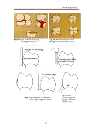 Reciprocal Tooth 4-mouth prep.pdf