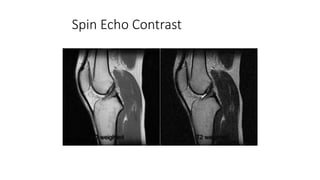 Spin Echo Contrast
PD weighted T2 weighted
 