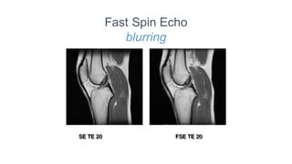 Fast Spin Echo
blurring
SE TE 20 FSE TE 20
 