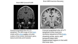 Coronal angulated slice of a T2
weighted, This MR image of the brain
shows white white matter and grey
matter of the cortex, brainstem, pons,
lateral ventricles and mastoid.
Brain MRI Coronal FLAIR
Coronal angulated slice of a T1
weigthed turbo inversion
recovery sequence of the brain,
showing cortex, pons, and
temporal lobes with
hippocampal regions in line with
the inner ears.
Brain MRI Inversion Recovery
 