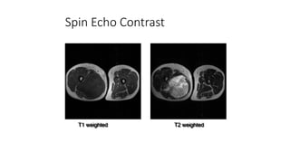 Spin Echo Contrast
T1 weighted T2 weighted
 