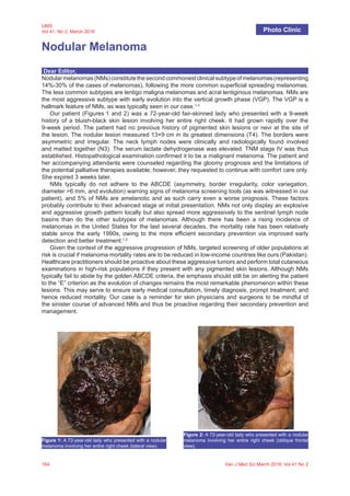 164 Iran J Med Sci March 2016; Vol 41 No 2
IJMS
Vol 41, No 2, March 2016
Nodular Melanoma
Photo Clinic
Dear Editor,
Nodularmelanomas(NMs)constitutethesecondcommonestclinicalsubtypeofmelanomas(representing
14%-30% of the cases of melanomas), following the more common superficial spreading melanomas.
The less common subtypes are lentigo maligna melanomas and acral lentiginous melanomas. NMs are
the most aggressive subtype with early evolution into the vertical growth phase (VGP). The VGP is a
hallmark feature of NMs, as was typically seen in our case.1-3
Our patient (Figures 1 and 2) was a 72-year-old fair-skinned lady who presented with a 9-week
history of a bluish-black skin lesion involving her entire right cheek. It had grown rapidly over the
9-week period. The patient had no previous history of pigmented skin lesions or nevi at the site of
the lesion. The nodular lesion measured 13×9 cm in its greatest dimensions (T4). The borders were
asymmetric and irregular. The neck lymph nodes were clinically and radiologically found involved
and matted together (N3). The serum lactate dehydrogenase was elevated. TNM stage IV was thus
established. Histopathological examination confirmed it to be a malignant melanoma. The patient and
her accompanying attendants were counseled regarding the gloomy prognosis and the limitations of
the potential palliative therapies available; however, they requested to continue with comfort care only.
She expired 3 weeks later.
NMs typically do not adhere to the ABCDE (asymmetry, border irregularity, color variegation,
diameter >6 mm, and evolution) warning signs of melanoma screening tools (as was witnessed in our
patient), and 5% of NMs are amelanotic and as such carry even a worse prognosis. These factors
probably contribute to their advanced stage at initial presentation. NMs not only display an explosive
and aggressive growth pattern locally but also spread more aggressively to the sentinel lymph node
basins than do the other subtypes of melanomas. Although there has been a rising incidence of
melanomas in the United States for the last several decades, the mortality rate has been relatively
stable since the early 1990s, owing to the more efficient secondary prevention via improved early
detection and better treatment.1,2
Given the context of the aggressive progression of NMs, targeted screening of older populations at
risk is crucial if melanoma mortality rates are to be reduced in low-income countries like ours (Pakistan).
Healthcare practitioners should be proactive about these aggressive tumors and perform total cutaneous
examinations in high-risk populations if they present with any pigmented skin lesions. Although NMs
typically fail to abide by the golden ABCDE criteria, the emphasis should still be on alerting the patient
to the “E” criterion as the evolution of changes remains the most remarkable phenomenon within these
lesions. This may serve to ensure early medical consultation, timely diagnosis, prompt treatment, and
hence reduced mortality. Our case is a reminder for skin physicians and surgeons to be mindful of
the sinister course of advanced NMs and thus be proactive regarding their secondary prevention and
management.
Figure 1: A 72-year-old lady who presented with a nodular
melanoma involving her entire right cheek (lateral view).
Figure 2: A 72-year-old lady who presented with a nodular
melanoma involving her entire right cheek (oblique frontal
view).
 