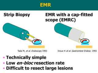 Endoscopy in Gastrointestinal Oncology - Slide 4 - I. Oda - Esophageal ...
